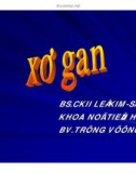 Tổng quan bệnh Xơ gan