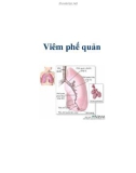 Tổng quan Viêm phế quản