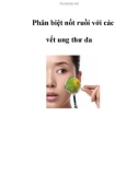 Phân biệt nốt ruồi với các vết ung thư da